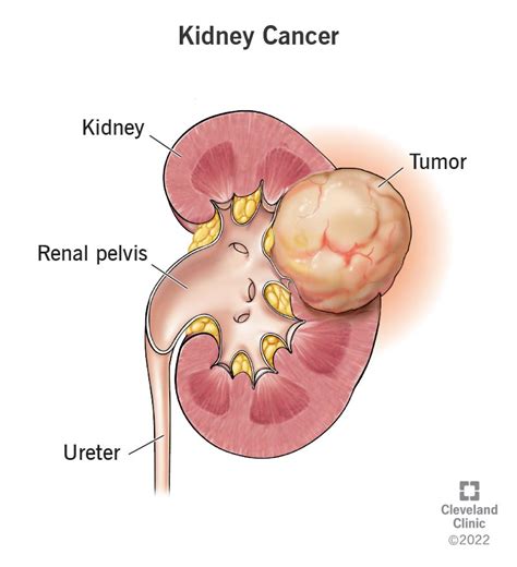 How To Diagnose Kidney Cancer - Soupcrazy1