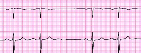 Sinoatrial Block - ECG Made Simple