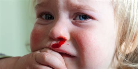 How to treat a blood nose in your toddler