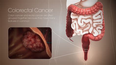 Colorectal cancer: Symptoms, Causes, and Treatment - Scientific Animations