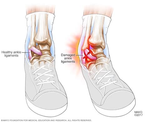 Sprained ankle - Symptoms and causes - Mayo Clinic