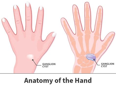 Ganglion Cysts Causes, Symptoms Treatment Hand Center, 41% OFF