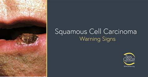 Squamous Cell Skin Cancer Lip