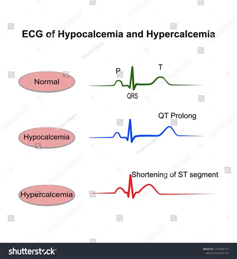 Ecg Changes In Hypocalcemia