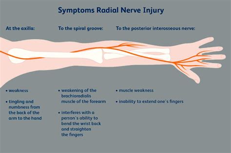 Radial Nerve: Peripheral Upper Extremity - El Paso, TX | Sciatica Pain ...