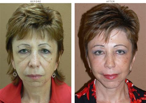 Mid Face Lift – Before and After Pictures * – Dr Turowski – Plastic Surgery Chicago