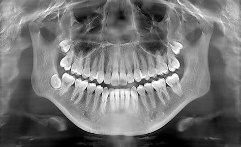 How safe are dental X-rays? - 3V Dental