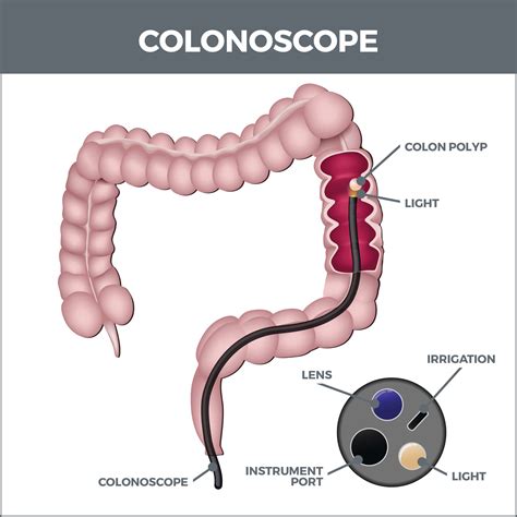 Colonoscopy | Gastro MD