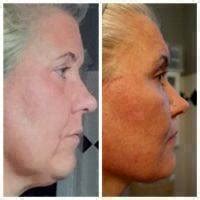 How Much Is A Lower Face Lift? Prices Of Surgeons » Facelift: Info, Prices, Photos, Reviews, Q&A