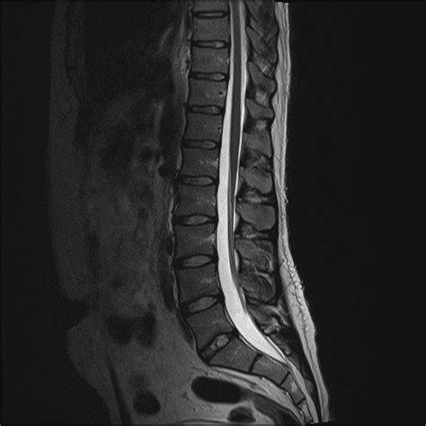 Lumbar Spine Mri Mri Scan Images Lumbar Spine Spine Anatomy Mri | Images and Photos finder