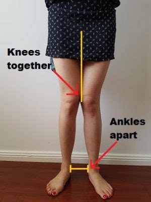 How To Fix Knee Valgus - Posture Direct