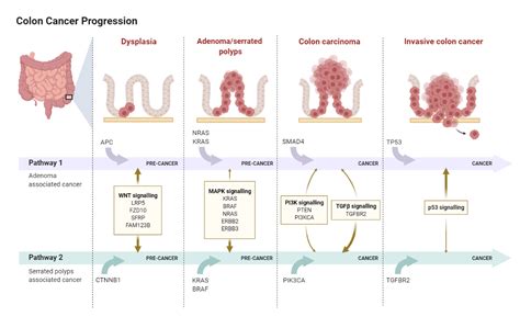 Colon Cancer Progression | BioRender Science Templates