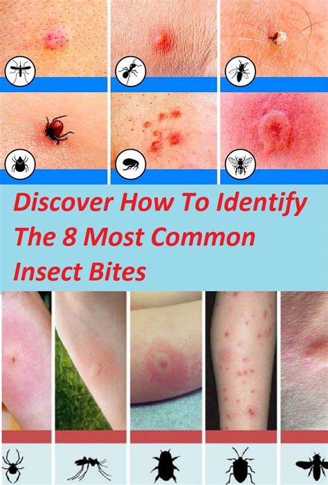 Discover How To Identify The 8 Most Common Insect Bites (With images) | Insect bites, Bug bites ...