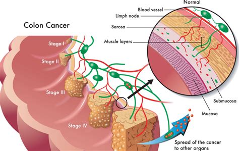 Colorectal Cancer Stages and Subtypes