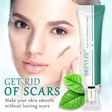 Acne Scar Removal Cream 30g Face Acne Treatment Cream Remove Stretch Markings Skin Repair Scar ...