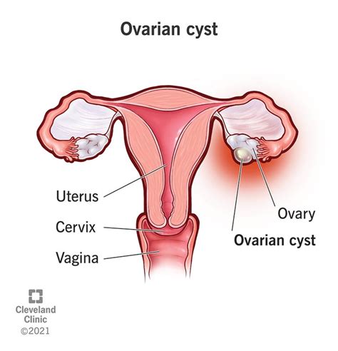 Ovarian Cysts: Causes, Symptoms, Diagnosis & Treatment | Flipboard