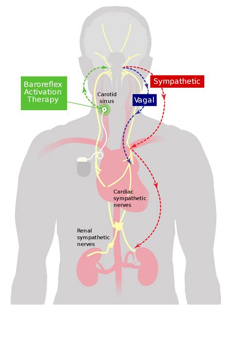 Baroreflex activation therapy - Wikipedia