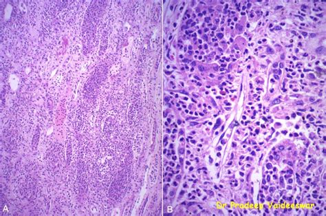 Pathology of Acute pyelonephritis - Pathology Made Simple