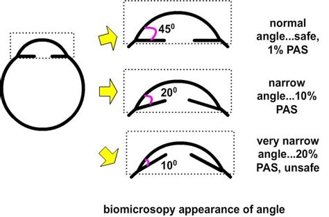 Anatomic Narrow Angles