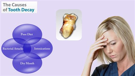 Tooth Decay - Cause, Symptoms And Treatment