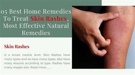 05 Best Home Remedies To Treat Skin Rashes, Most Effective Natural ...