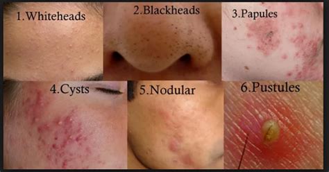 Acne Inflammation