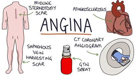 Understanding Angina: Visual Explanation for Students - YouTube