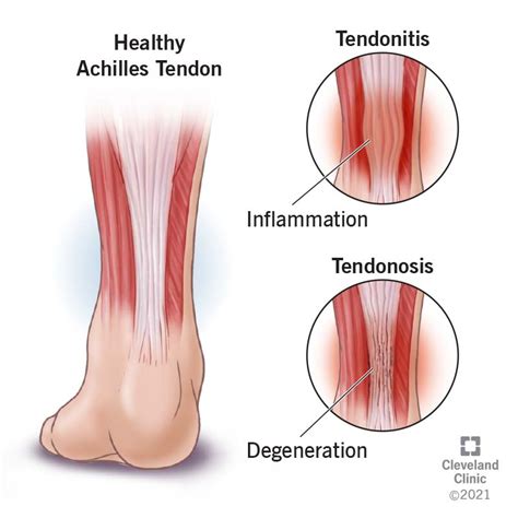 Tendinopathy: Symptoms, Causes & Treatment | Flipboard