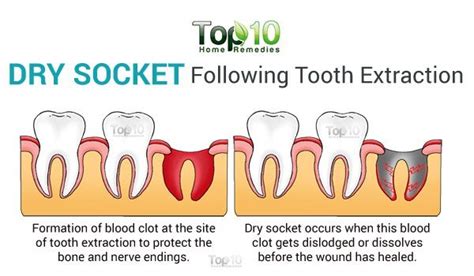 Home Remedies for Dry Socket | Top 10 Home Remedies