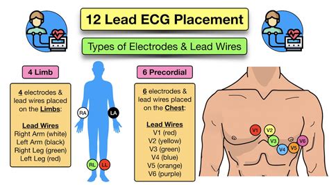 12 Lead ECG Placement: Diagram and Mnemonic for Limb and Precordial ...