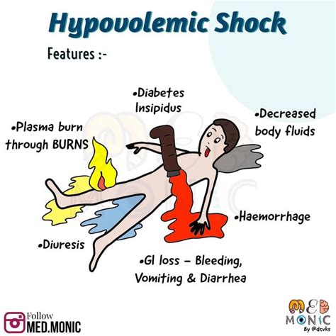 Hypovolemic Shock Features: Medical Mnemonics