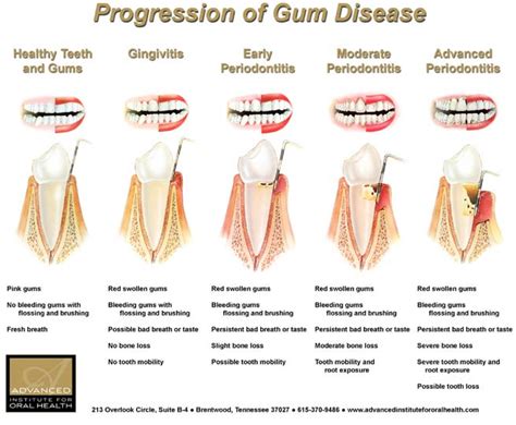 Gum Disease (Gingivitis): Causes, Risk Factors ,Symptoms and Treatment