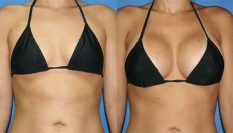 Hyaluronic Acid Breast Augmentation Injection Filler , Breast Enlargement Fillers