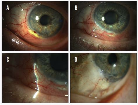 Scleral Edema