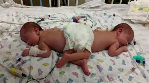 Conjoined sisters undergo rare separation surgery - CNN Video