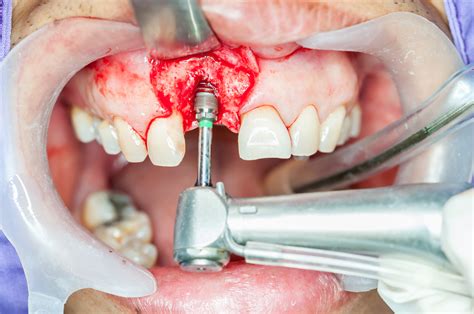 What You Need To Know About Dental Bone Graft Surgery - USIW.org