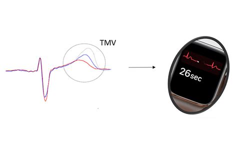 Items - Could T-wave morphology on a single-lead ECG heartbeat help to ...