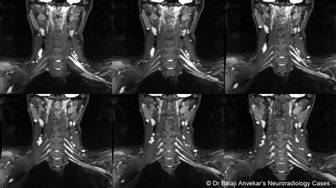 Dr Balaji Anvekar FRCR: Brachial plexitis MRI