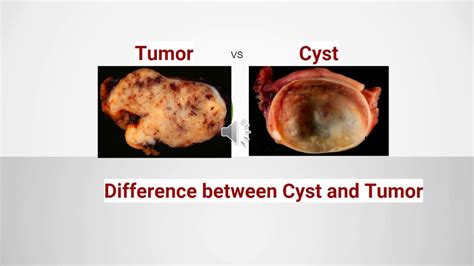 Malignant Tumor