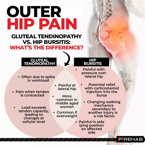 Hip Bursitis Versus Gluteal Tendinopathy - [P]rehab