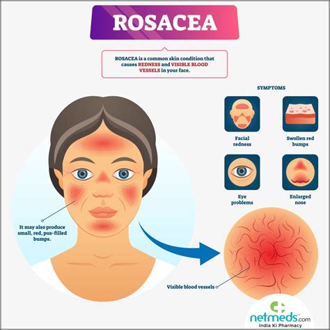 Rosacea: Causes, Symptoms And Treatment | Netmeds