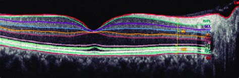 Segmented view of the retinal layers created using the Heidelberg... | Download Scientific Diagram