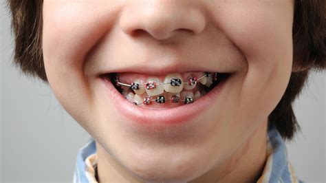 Kids Braces | Why is Early Dental Intervention Important?