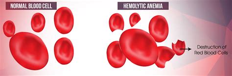 Hemolytic Anemia - Causes, Symptoms, Treatment