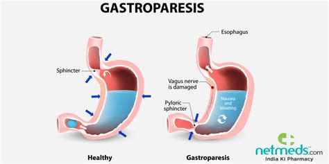 Gastroparesis: Causes, Symptoms And Treatment