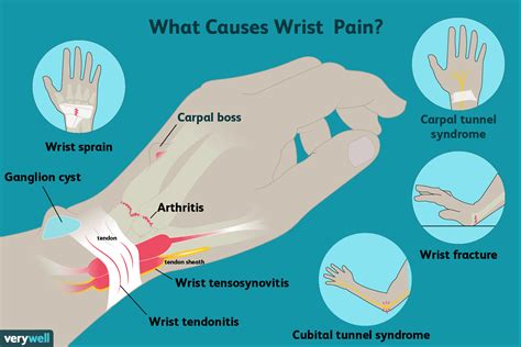 Wrist Pain: Causes, Symptoms, and Treatment - Verywell Health | Hiswai