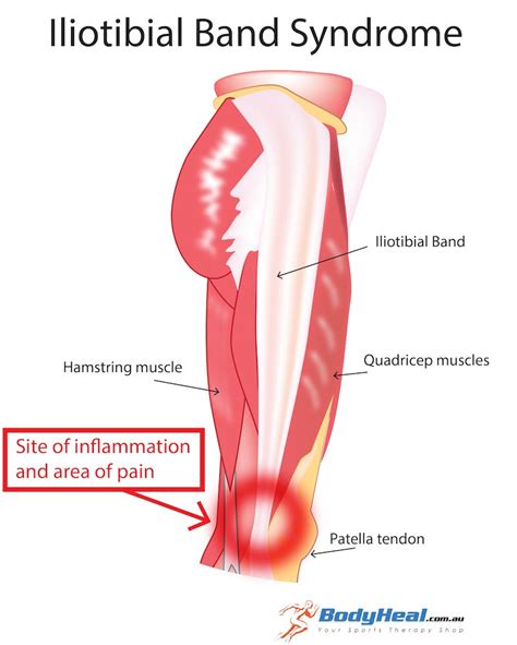 What Is Iliotibial Band Syndrome? Symptoms, Causes & Treatment Options – BodyHeal