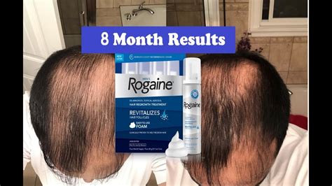 Does Rogaine REALLY Work??? 8 Month RESULTS | MENS ROGAINE (5% Minoxidil) Hair Regrowth ...