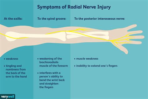 Radial Nerve Pain: Causes and Treatments