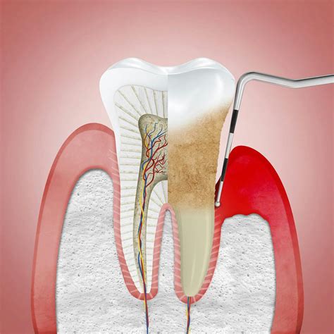 What Is Periodontitis? | parodontax